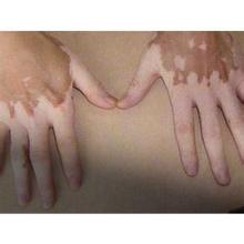 节段型白癜风日常生活中该怎么护理